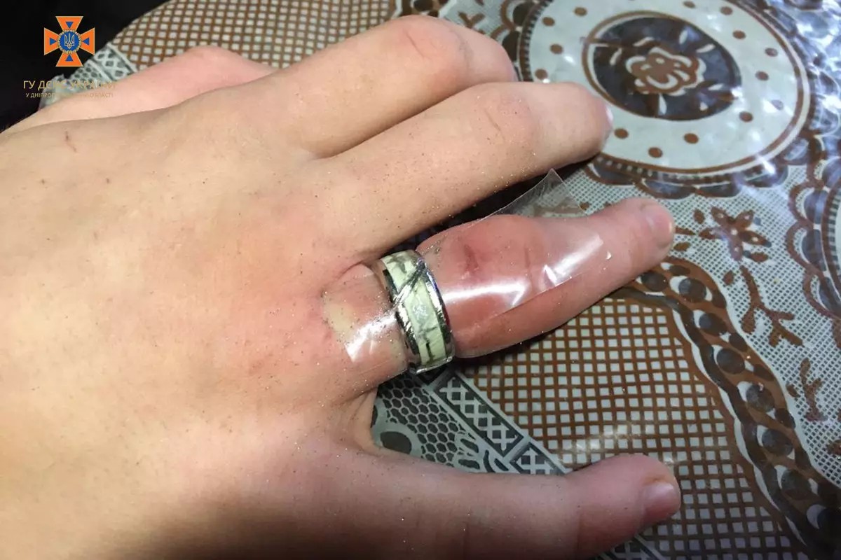 На Дніпропетровщині рятувальники допомогли хлопцю зняти каблучку з пальця 