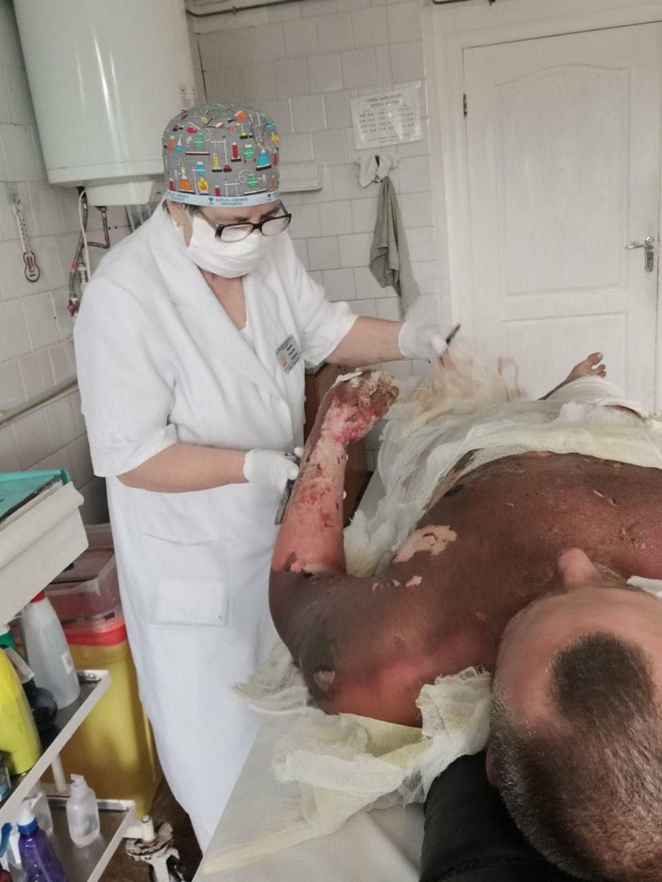 У лікарні Дніпра врятували бійця з опіком 90 % поверхні тіла